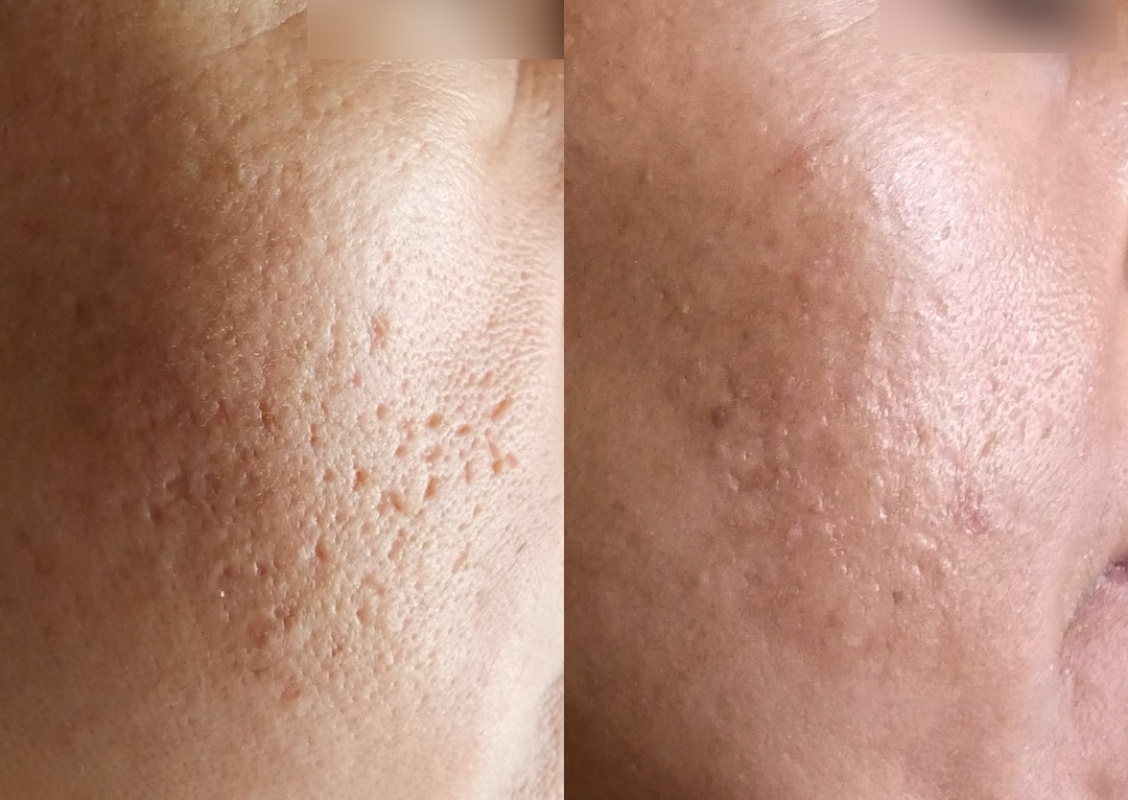 Skin Lightning